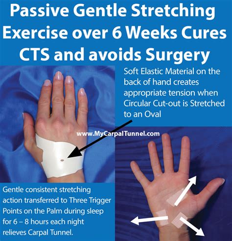 Do Stress Balls Work For Carpal Tunnel - To Work Pertamina