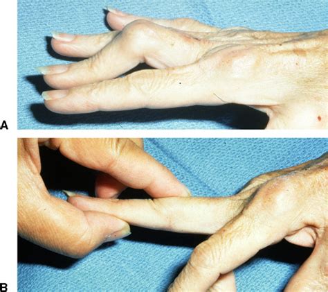 Treatment of boutonniere finger deformity in rheumatoid arthritis. | Semantic Scholar