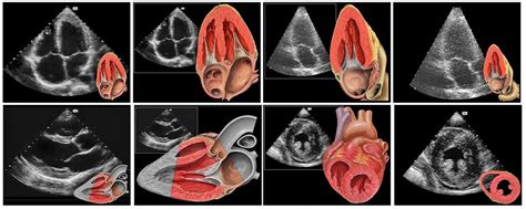 TTE : Transthoracic Echocardiogram - SIFSOF . CA