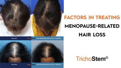 Treating Factors of Menopause Hair Loss, and Female Pattern Hair Loss ...