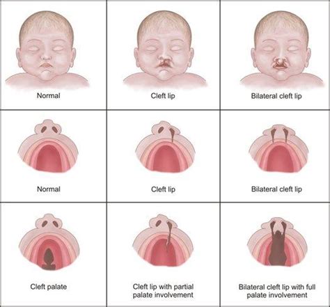 The truth about cleft lip and cleft palate : Tourism Focus