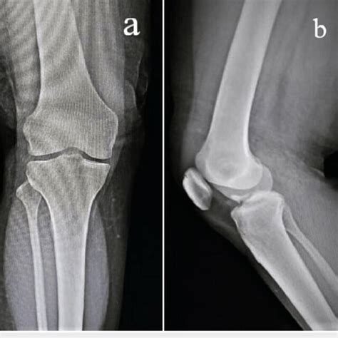 MRI of left knee shows diffuse nodular synovial hypertrophy in T2W (a ...