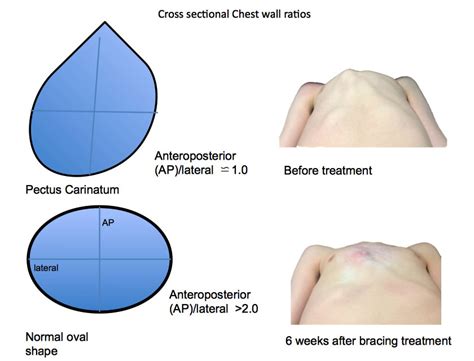 Pectus carinatum causes, symptoms and treatment | Braceworks Custom ...