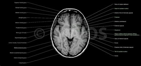 Cross sectional anatomy of the brain : a module based on MRI | Mri ...