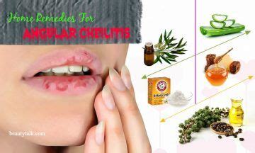 10 Natural Home Remedies For Angular Cheilitis Infection