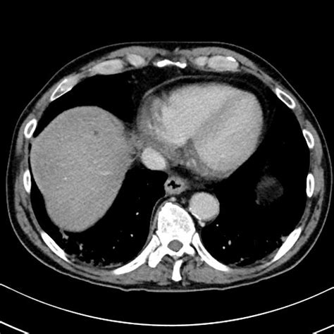 File:Chronic appendicitis complicated by appendicular abscess, pylephlebitis and liver abscess ...