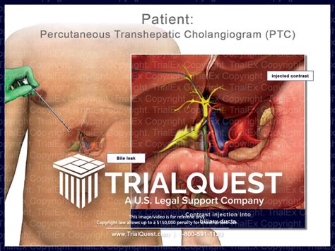 Cholangiography Procedure –, 51% OFF | www.micoope.com.gt