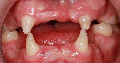 How are teeth affected by E D? - Ectodermal Dysplasia Society