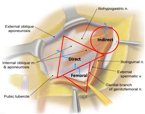 Indirect Vs Direct Inguinal Hernia