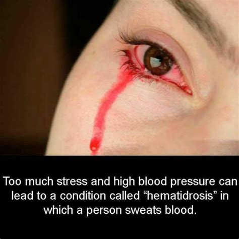 Hematidrosis: a very rare condition in which a human sweats blood ...