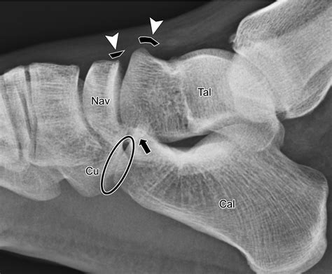 Chopart Fracture Dislocation Radiology Reference Article | The Best ...