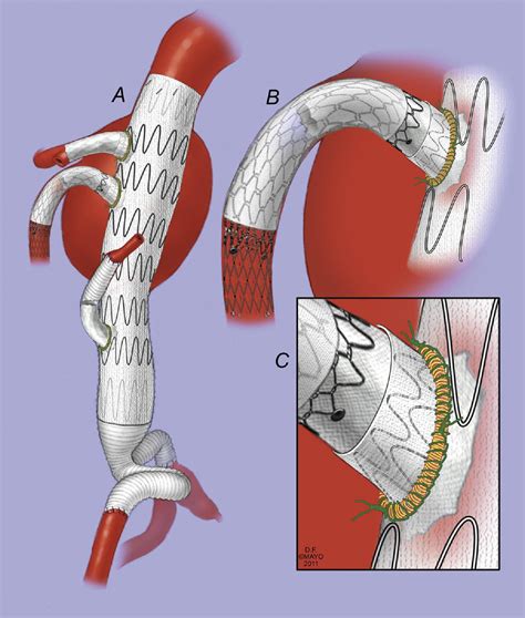 Stent graft modification with mini-cuff reinforced fenestrations for ...