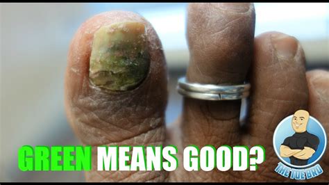 Green Fungus On Nails / Nail Fungus Symptoms And Causes Mayo Clinic ...