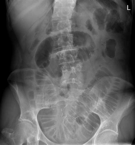 Small bowel obstruction - adhesions - Radiology at St. Vincent's University Hospital