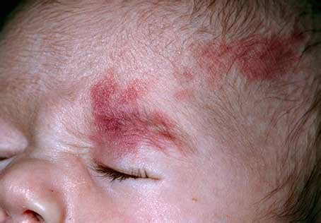 Nevus Simplex Newborn