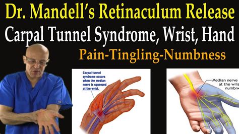 Retinaculum Release for Carpal Tunnel Syndrome, Wrist, Hand Pain (Self ...