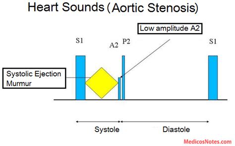 Heart sounds and murmur in Aortic stenosis | Heart sounds, Aortic stenosis, Stenosis