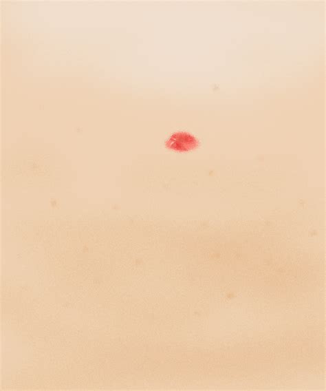 Tiny Red Blood Spots On Skin / Little Red Spots On Skin Learn The ...