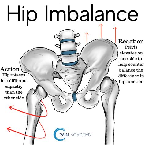 Hip Imbalance – Pain Academy | Anatomia musculos, Anatomía humana, Anatomía