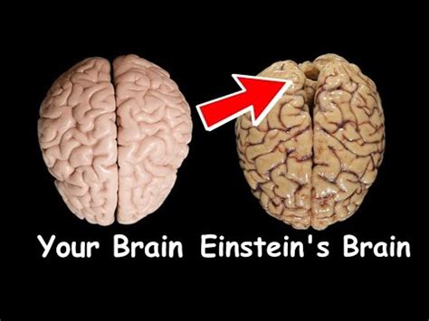 How Albert Einstein's brain was different from a normal human brain? Einstein's brain after ...