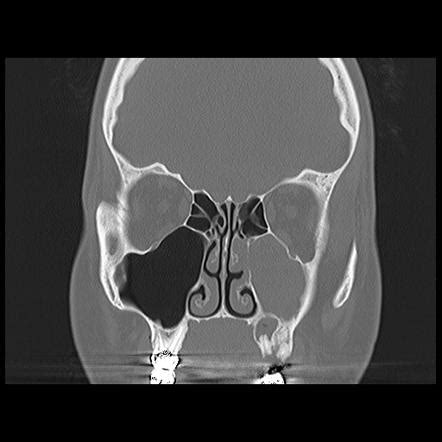 Odontogenic sinusitis | Radiology Reference Article | Radiopaedia.org