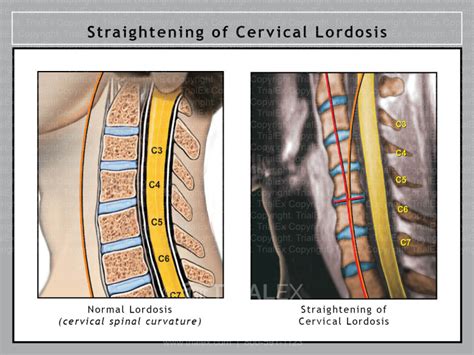 Straightening Of Normal Cervical Lordosis