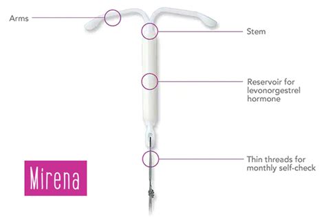 Types of IUDs | CU PAG