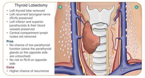 Minimally Invasive Thyroidectomy - Larian, MD