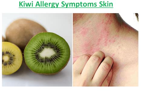 Kiwi Allergy Symptoms and Treatment - Fruits Facts