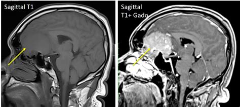 Olfactory groove meningioma – Radiology Cases