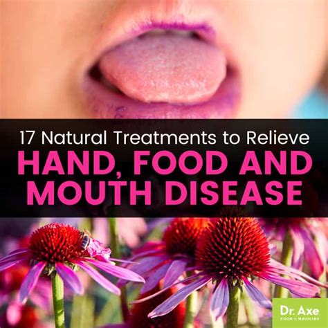 Hand Foot Mouth Disease Treatment Diet - rutrackerhospital