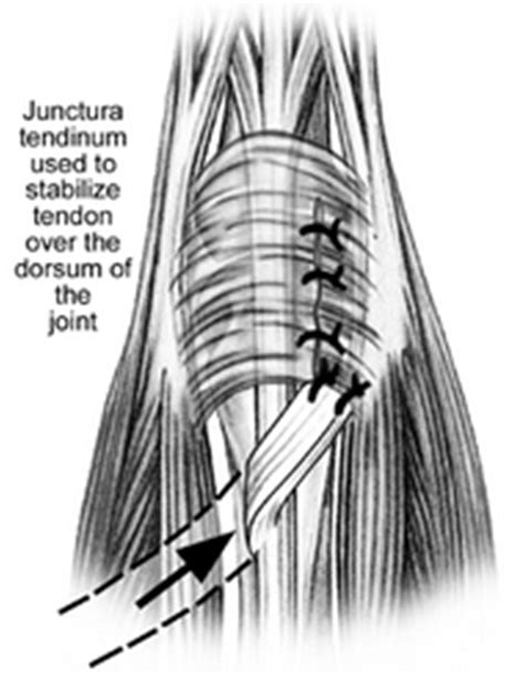 Sagittal Band Rupture Splint