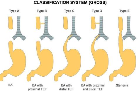 Tracheoesophageal Fistula | 100% Best Explanation