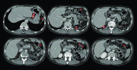 Abdominopelvic CT showing multiple soft-tissue lesions caused by the ...