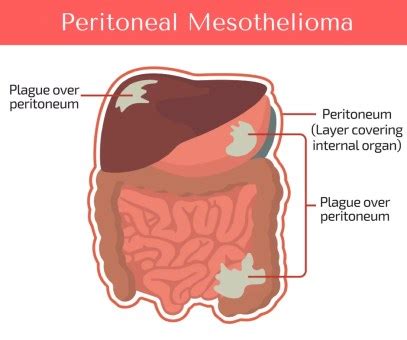 Symptoms of Mesothelioma lung cancer and their treatment options