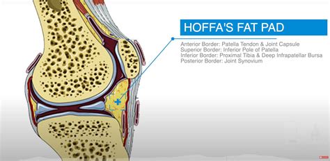 Infrapatellar Fat Pad Syndrome | Diagnosis & Treatment