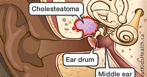 ear - MASTOIDECTOMY - Dr. Meenesh Juvekar - ENT Specialist