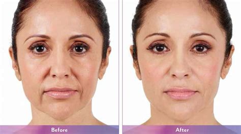 Liquid face lift with Juvederm - Healthynewage.com