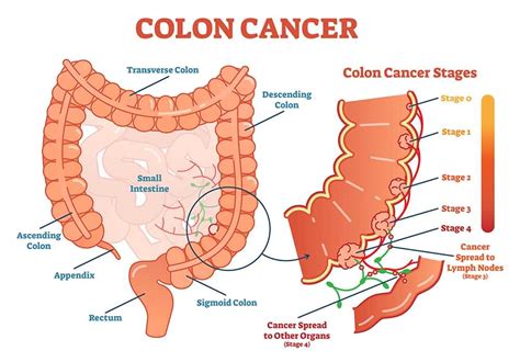 Colon Cancer; Stages, Symptoms, Causes and Screening