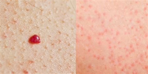 Small tiny pinpoint red dots on skin - kizacenters