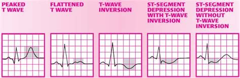 EKG - Angina Pectoris : 네이버 블로그