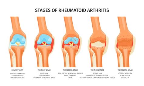 Four Stages Of Knee Arthritis – NBKomputer