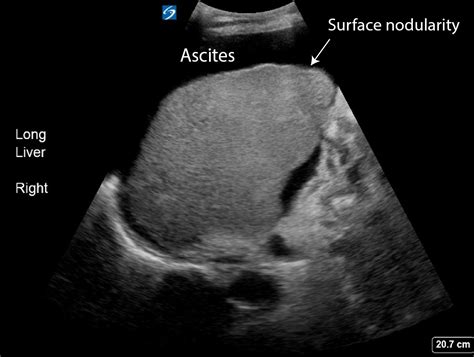 Alcoholic cirrhosis - Critical Care Sonography