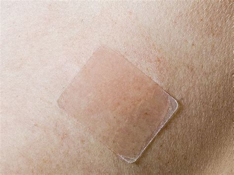 Daytrana ADHD Patch May Cause Permanent Skin Color Changes