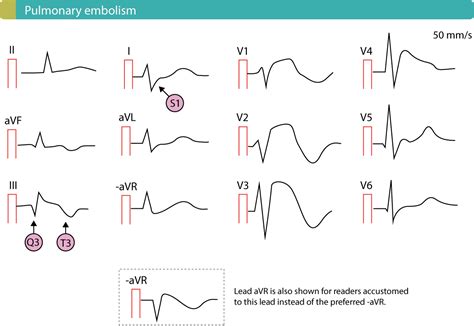 Pulmonary Embolism (PE): Causes, symptoms, diagnosis, treatment