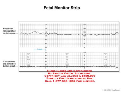 Fetal Monitor Strip