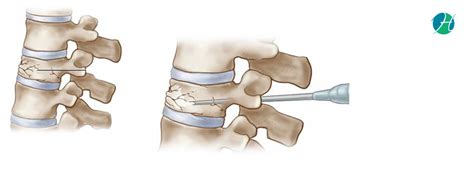 Vertebroplasty: Indications and Complications – Healthsoul