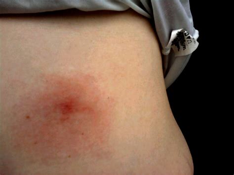 lyme bullseye rash pictures - pictures, photos