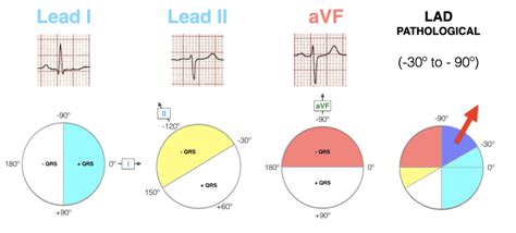 Left Axis Deviation (LAD) • LITFL • ECG Library Diagnosis