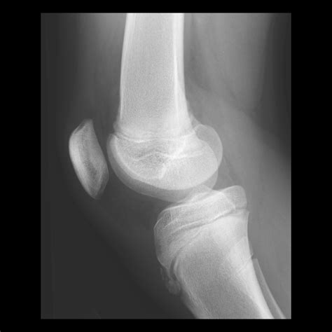 osgood-schlatter disease | pacs